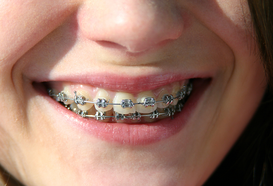 Achieve a Straighter Smile with Braces in Panorama City, CA