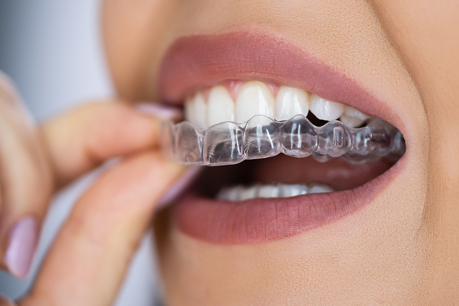 Achieve a Straighter Smile with Clear Aligners in Panorama City, CA