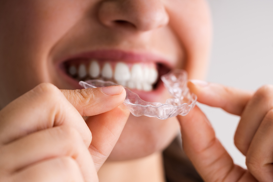 Transform Your Smile with Clear Aligners in Panorama City, CA – A Modern Alternative to Braces