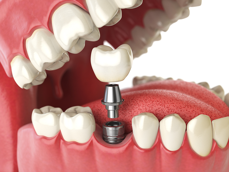 Dental Implants: The Ultimate Solution for a Healthy and Confident Smile in Panorama City, CA