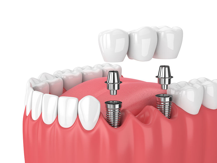 Restore Your Smile with Dental Implants in Panorama City, CA