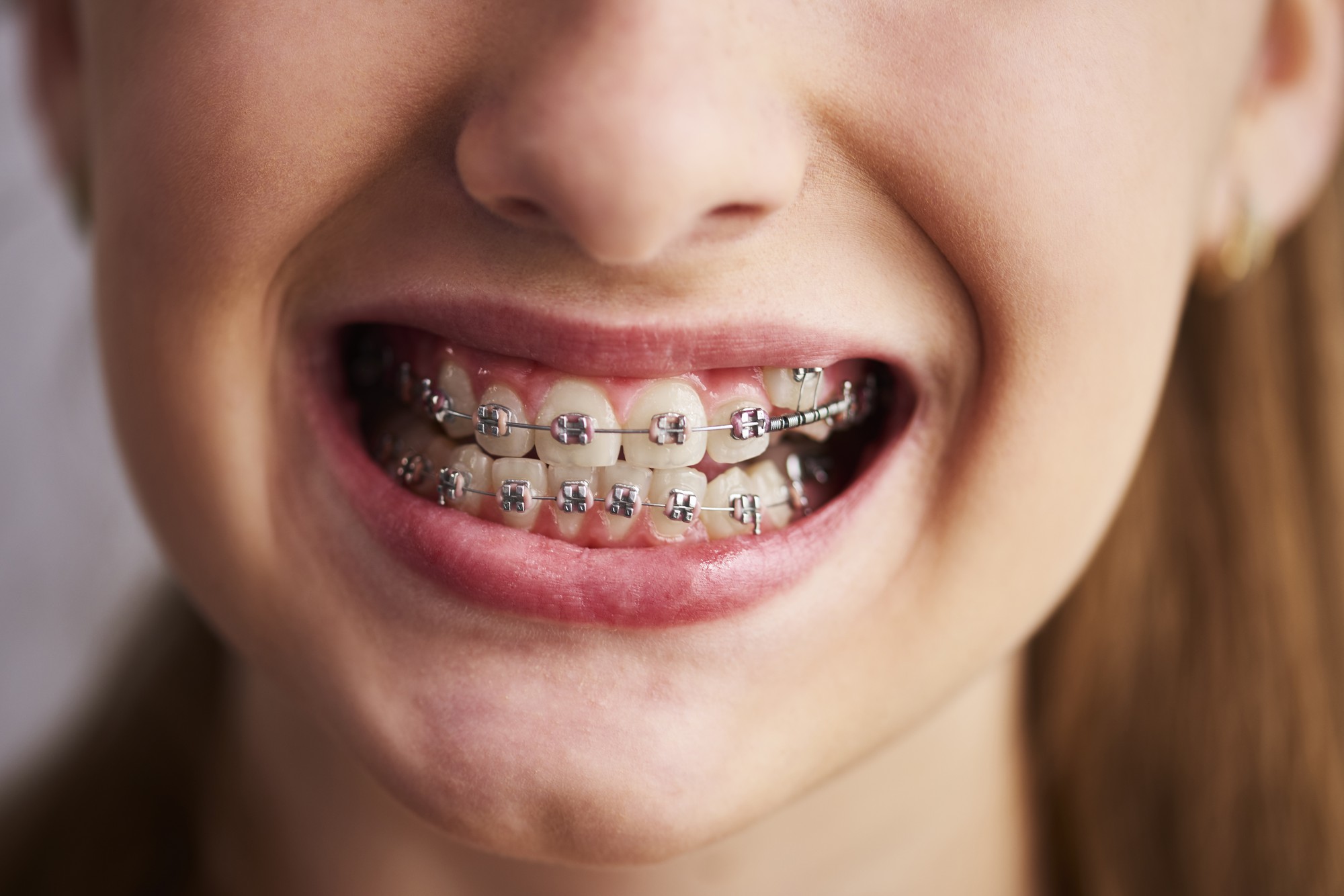 Achieve a Perfect Smile with Traditional Wire Braces in Panorama City, CA